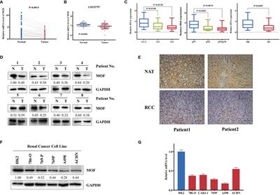 The Histone Acetyltransferase MOF Regulates SIRT1 Expression to Suppress Renal Cell Carcinoma Progression